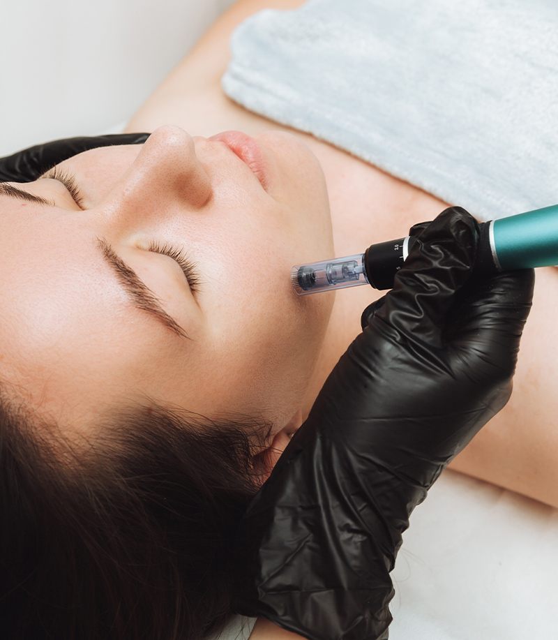 microneedling