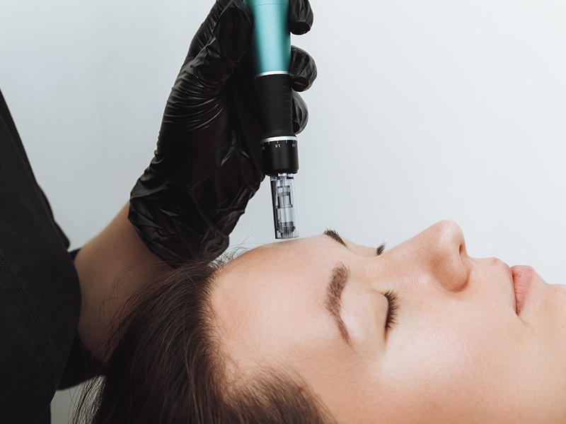 Microneedling
